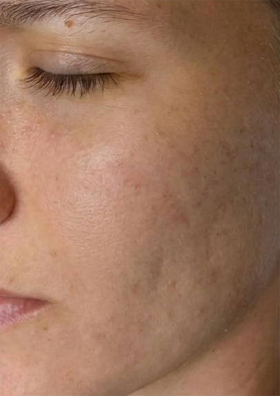 Skin after microneedling