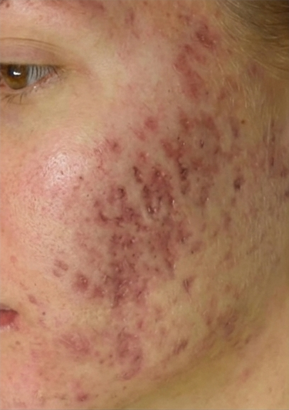 Skin before microneedling
